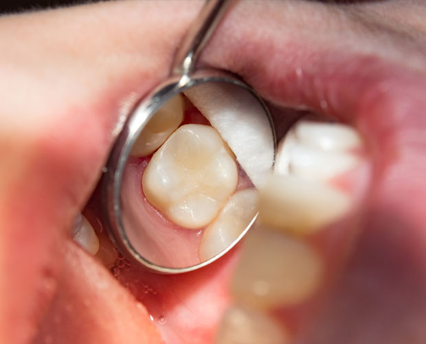 ORMOCER®-based composites for dental medicine